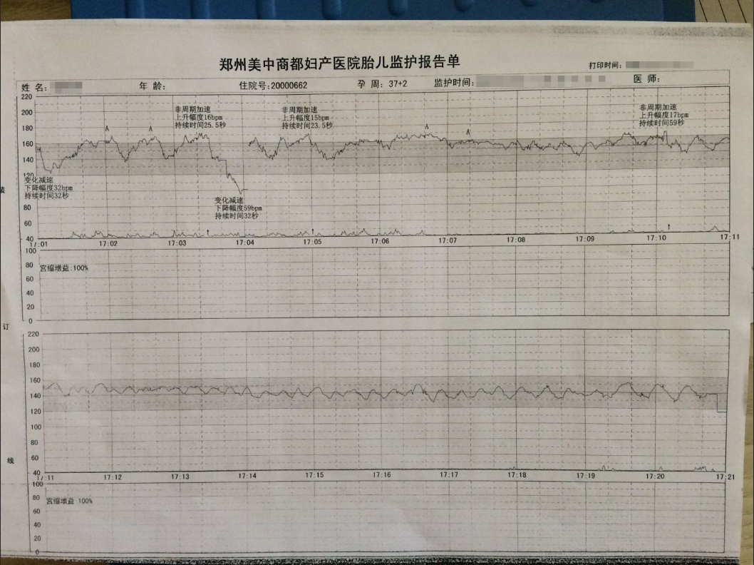 y女士来到医院,李主任安排她做胎心监护,李主任观察前5分钟胎监表现还