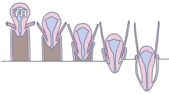 子宫脱垂图解