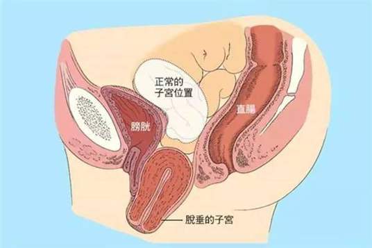 子宫脱垂产后有什么表现