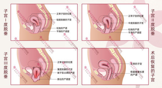 三度子宫脱垂