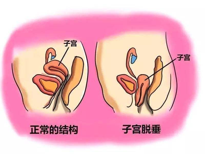 产后子宫脱垂手术方法效果好不好